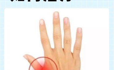 大拇指腱鞘炎怎么治疗?一文读懂从保守到手术的全方案