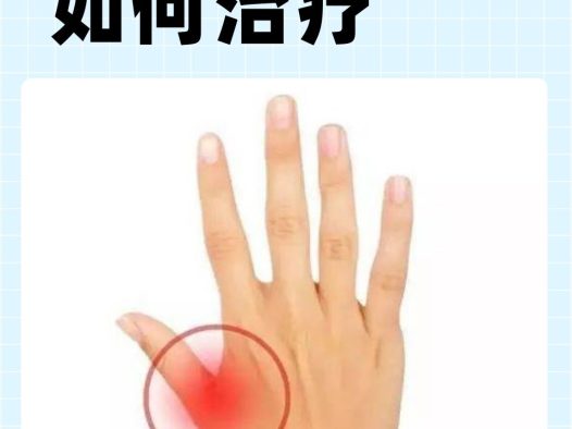 大拇指腱鞘炎怎么治疗?一文读懂从保守到手术的全方案